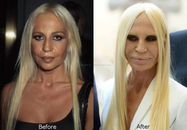 Danatella Versace antes e depois e1617444943292