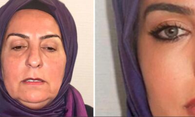 Antes e depois de plastica em idosa na Turquia causa