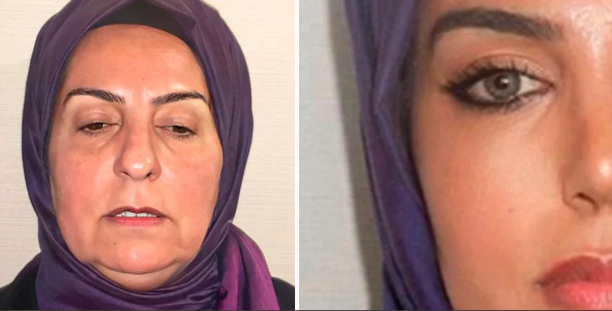 Antes e depois de plastica em idosa na Turquia causa