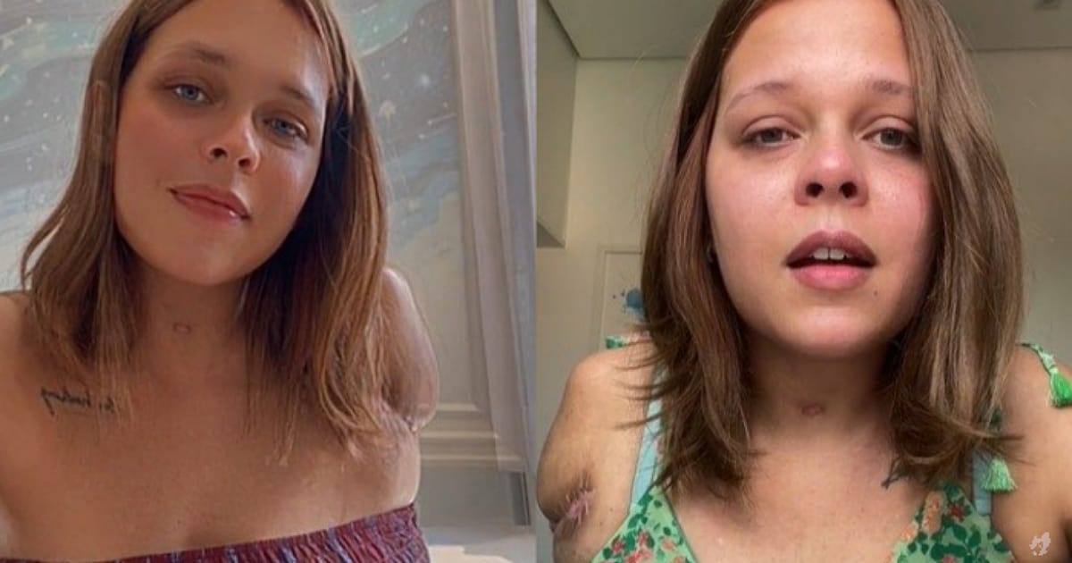 Jovem é internada com asma e sai de hospital com braço amputado – Coisas de Casal 31 card__image