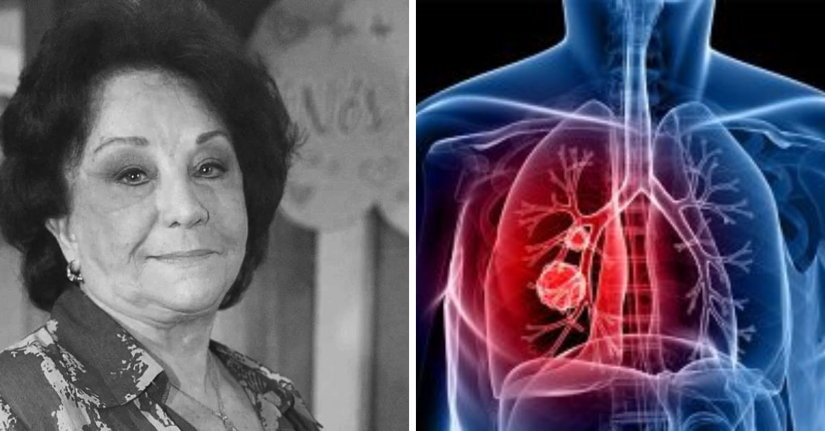 Causas, sintomas e tratamento da doença que tirou a vida da atriz e apresentadora Lolita 31 Causas sintomas e tratamento da doenca que tirou a vida