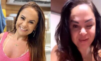 Empresaria expoe complicacao apos aplicacao botox caso serve de alerta