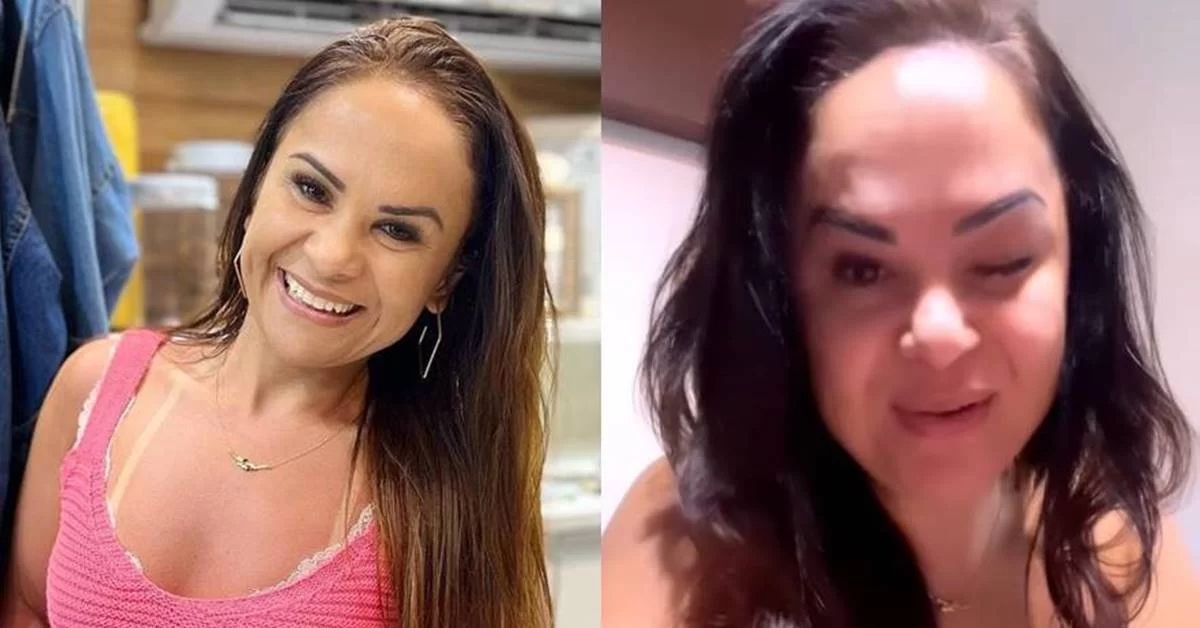 Empresária expõe complicação após aplicação botox; caso serve de alerta 31 Empresaria expoe complicacao apos aplicacao botox caso serve de alerta