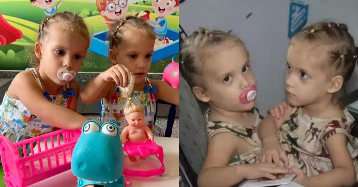 1 ano após cirurgia, recuperação das gêmeas siamesas Heloá e Valentina deixa família emocionada 31 1 ano apos cirurgia recuperacao das gemeas siamesas Heloa e
