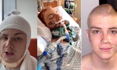 Apos acidente grave jovem contrai infeccao e tem cranio removido