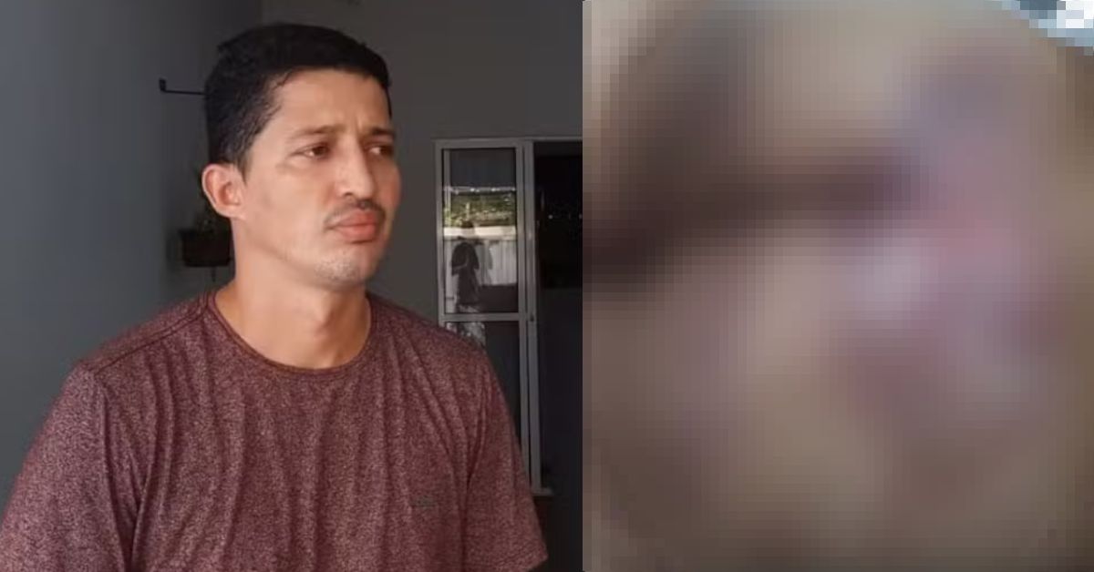 Homem vai fazer cirurgia no nariz e deixa clínica com graves queimaduras nas nádegas e pernas 31 Homem vai fazer cirurgia no nariz e deixa clinica com
