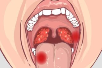 Esses sao os sintomas de cancer de boca que voce