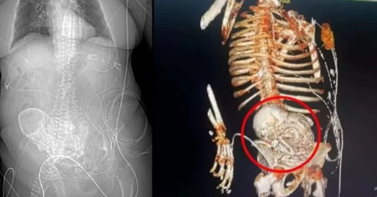 idosa de 86 anos descobriu feto calcificado por cerca de