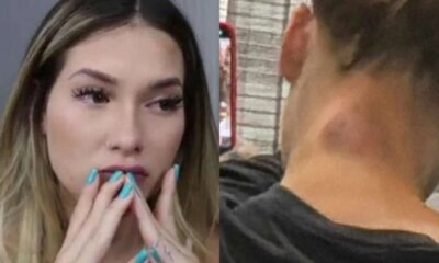 Gravida Virginia Fonseca surge com enorme hematoma roxo no pescoco