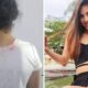 Policia prende suspeita de jogar acido em jovem ela confessou