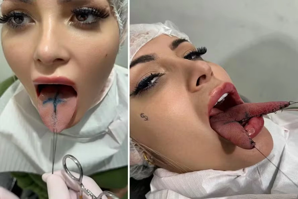 Andressa Urach desabafa após cortar a língua ao meio através de procedimento: ‘salivando bastante’ 31 Andressa Urach desabafa apos cortar a lingua ao meio atraves