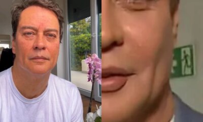 Marcello Antony faz harmonizacao facial e resultado deixa internautas boquiabertos