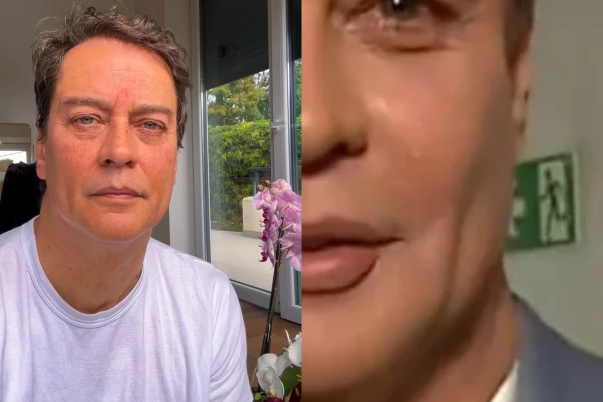 Marcello Antony faz harmonização facial e resultado deixa internautas boquiabertos: ‘que dó’ 35 Marcello Antony faz harmonizacao facial e resultado deixa internautas boquiabertos