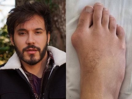 Ex-BBB Eliezer faz nova cirurgia, retira os joanetes e resultado assusta 31 Ex-BBB Eliezer faz nova cirurgia, retira os joanetes e resultado assusta