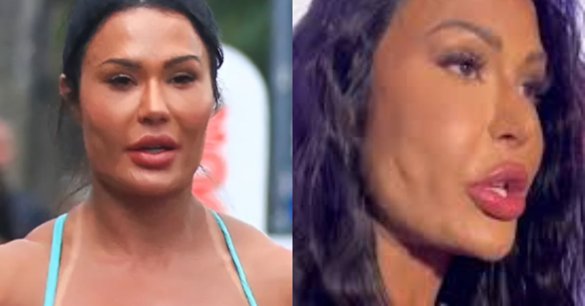 Gracyanne Barbosa reverte procedimentos estéticos no rosto e mostra resultado; video 31 Gracyanne Barbosa reverte procedimentos esteticos no rosto e mostra resultado