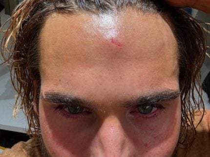 Nicolas Prattes leva coronhada em gravação e exibe machucado: “Foi de verdade” 31 Nicolas Prattes leva coronhada em gravação e exibe machucado: “Foi de verdade”