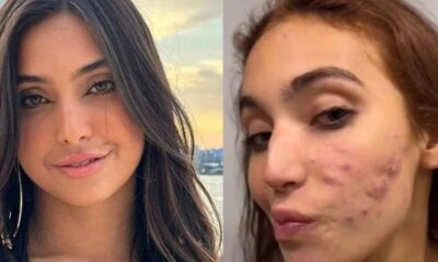 Vanessa Lopes desabafa sobre autoestima abalada por tratamento de acne