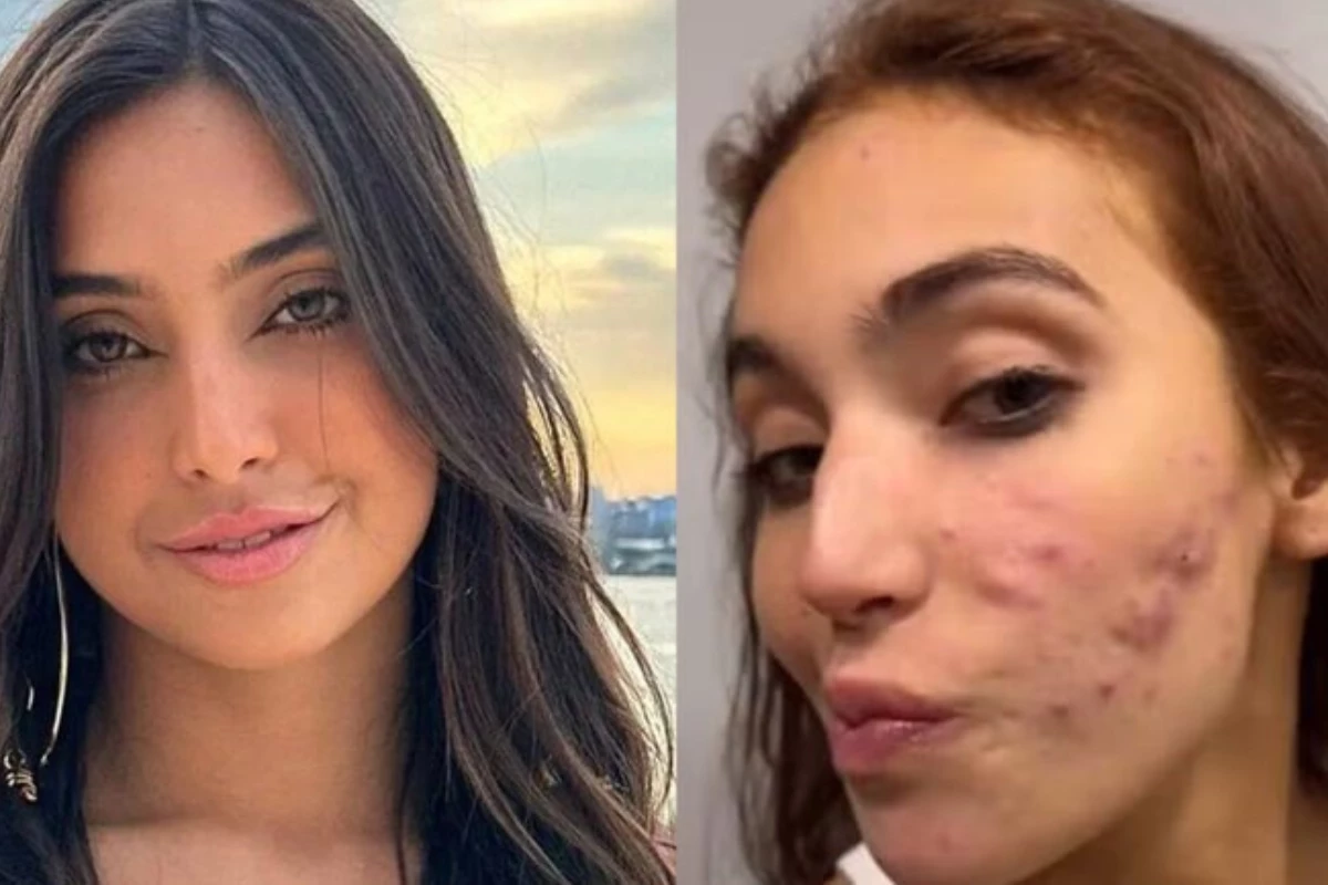 Vanessa Lopes desabafa sobre autoestima abalada por tratamento de acne: ‘Eu não aguento mais’ 31 Vanessa Lopes desabafa sobre autoestima abalada por tratamento de acne