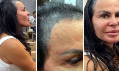 Gretchen aparece careca e motivo e exposto
