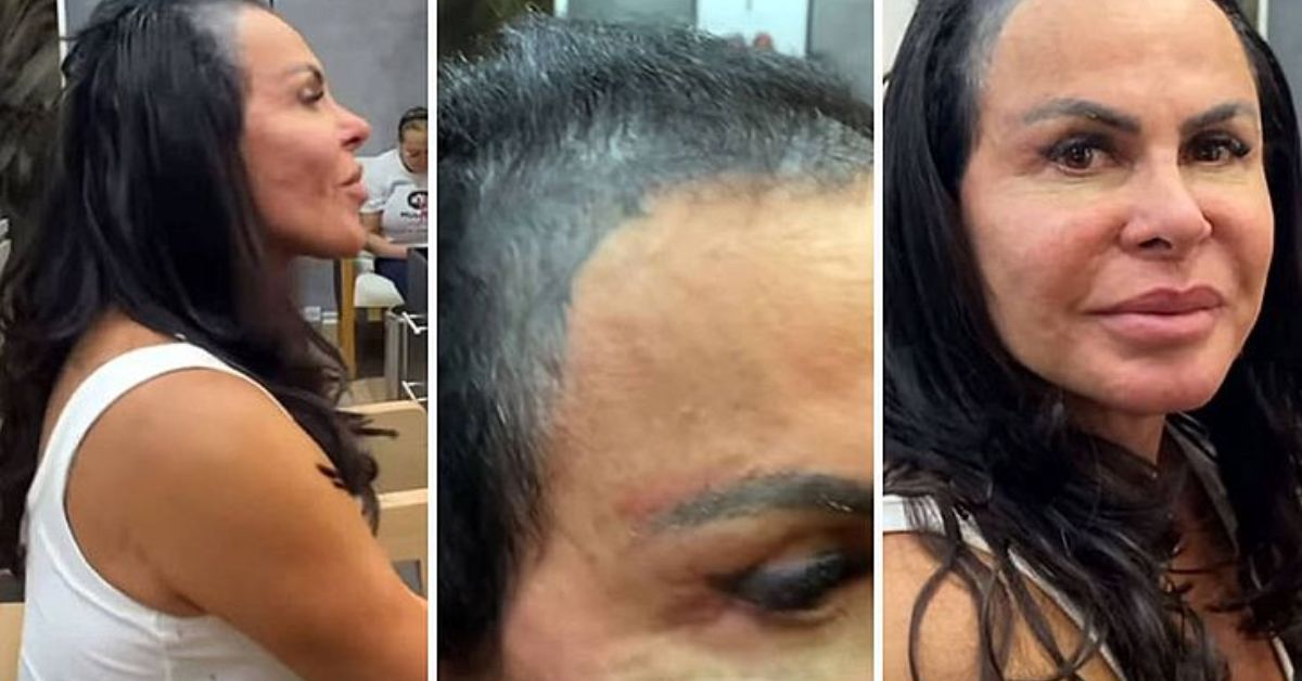 Gretchen aparece careca e motivo e