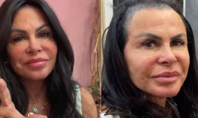 Gretchen e detonada apos exibir parte do couro cabelo careca