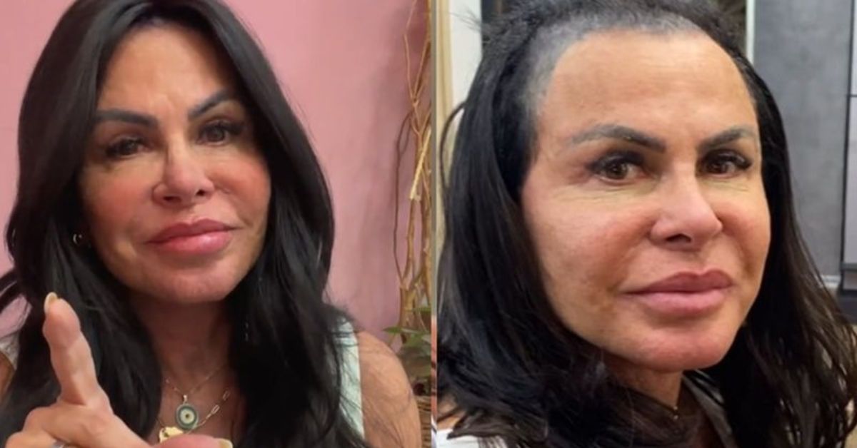 Gretchen e detonada apos exibir parte do couro cabelo careca