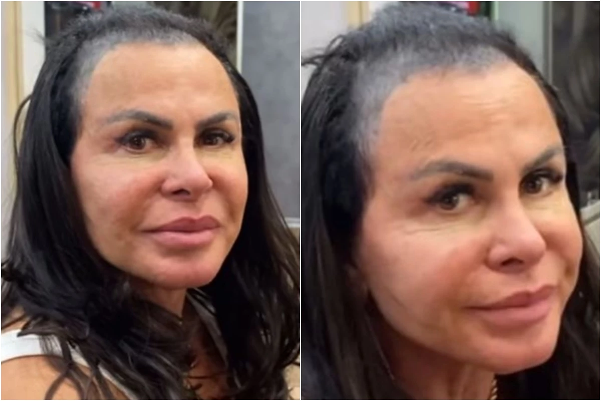 Gretchen mostra cabelo sem prótese capilar e chama a atenção: ‘perdi todo o cabelo’ 31 Gretchen mostra cabelo sem protese capilar e chama a atencao
