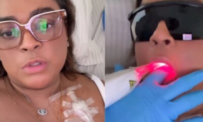 Preta Gil retoma quimioterapia e adota Laserterapia para combater mucosites