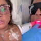 Preta Gil retoma quimioterapia e adota Laserterapia para combater mucosites