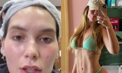 Virginia vai mexer no rosto e bumbum; entenda como funcionam os procedimentos