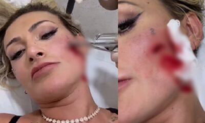 Andressa Urach leva pontos no rosto apos briga feia com