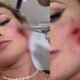 Andressa Urach leva pontos no rosto apos briga feia com
