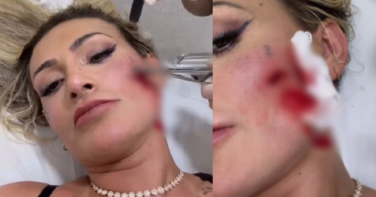 Andressa Urach leva pontos no rosto apos briga feia com
