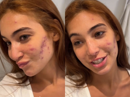 Em tratamento para acne, Vanessa Lopes relata ter se acostumado com ofensas 31 Em tratamento para acne, Vanessa Lopes relata ter se acostumado com ofensas