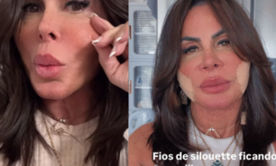 Gretchen aparece sem curativos e rebate haters que a chamaram de “fofão”