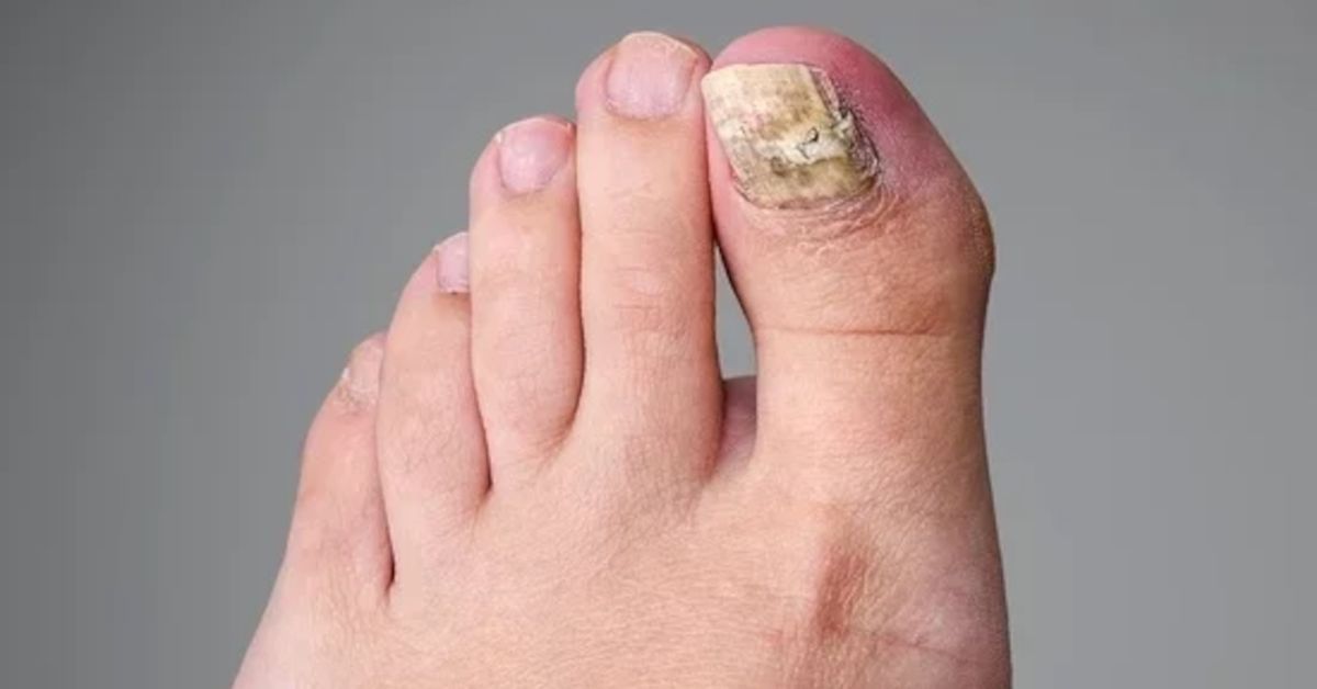Receita caseira pode ajudar no combate contra micose nas unhas 31 Receita caseira pode ajudar no combate contra micose nas unhas