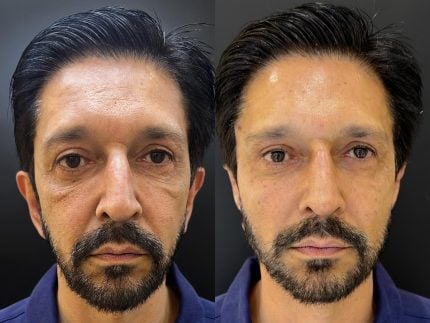 Reeleito, prefeito de São Paulo dá um tapa no visual e passa por rejuvenescimento. Veja! 31 Reeleito, prefeito de São Paulo dá um tapa no visual e passa por rejuvenescimento. Veja!