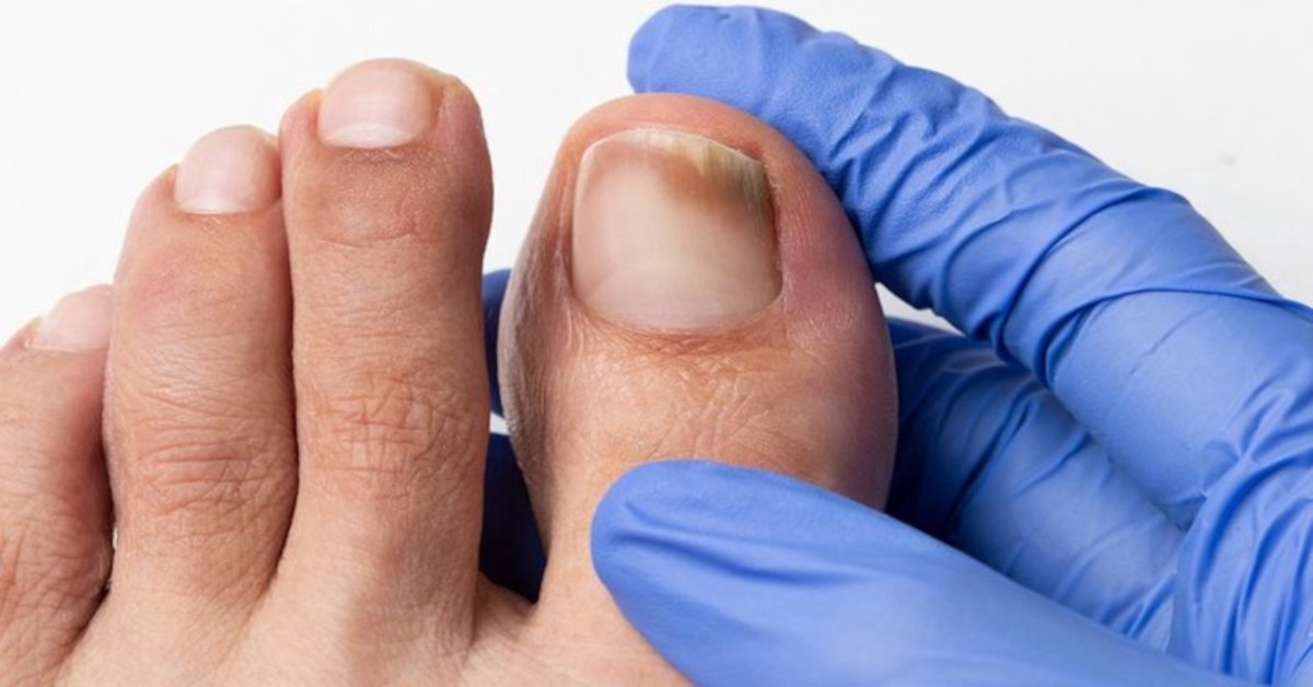 Câncer na unha pode ser confundido com micose? Aprenda a diferenciar os sintomas 31 Cancer na unha pode ser confundido com micose Aprenda a