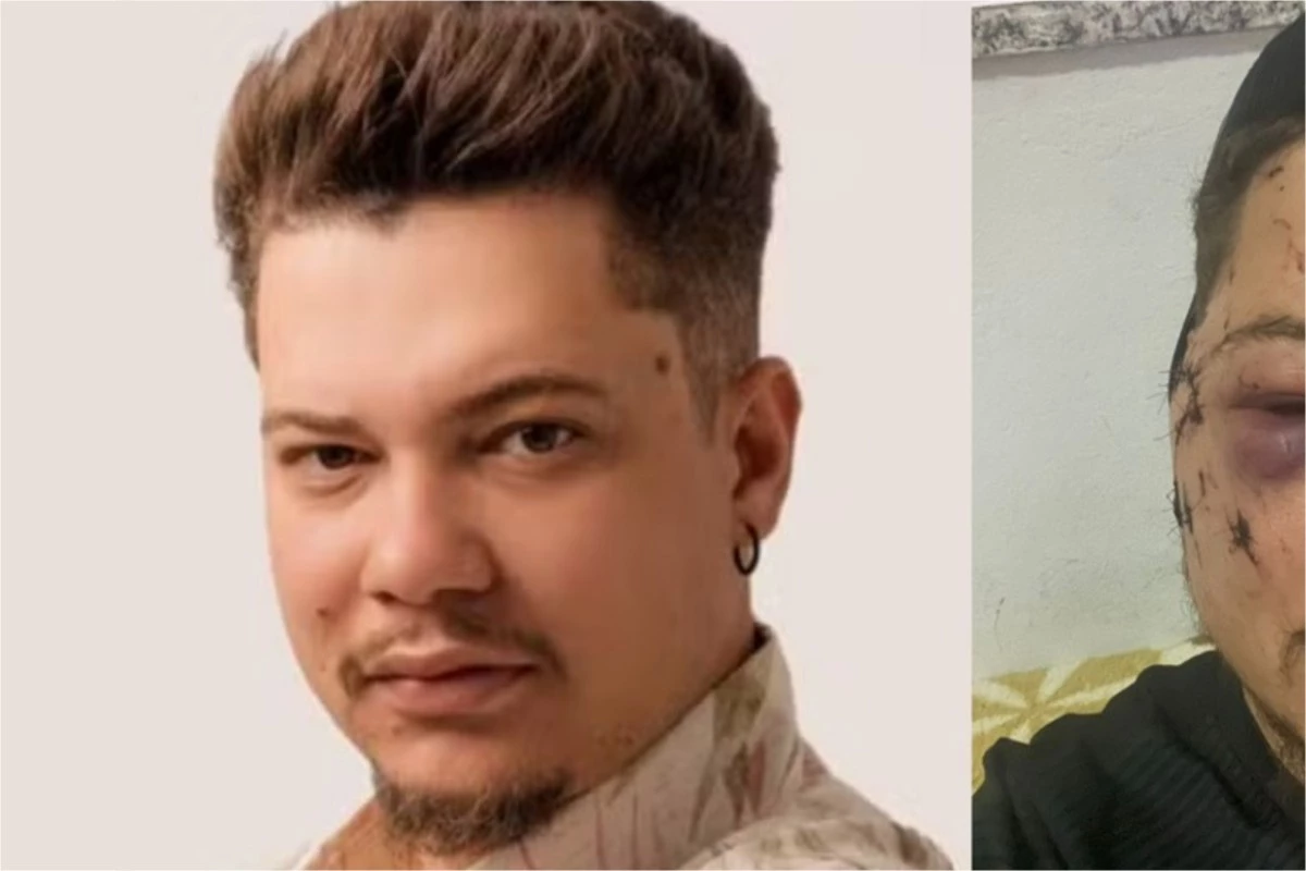 Cantor sertanejo leva garrafada em show e desabafa: ‘estou com o rosto desfigurado’ 33 Cantor sertanejo leva garrafada em show e desabafa ‘estou com