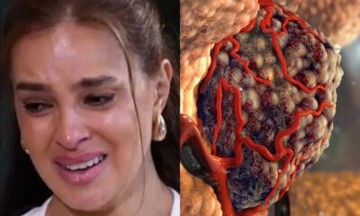 Com cancer raro Vera Viel mostra cicatrizes apos radioterapia e