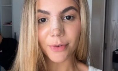 Ex BBB Hariany se arrepende de procedimento com PMMA Efeitos irreversiveis