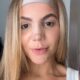 Ex BBB Hariany se arrepende de procedimento com PMMA Efeitos irreversiveis