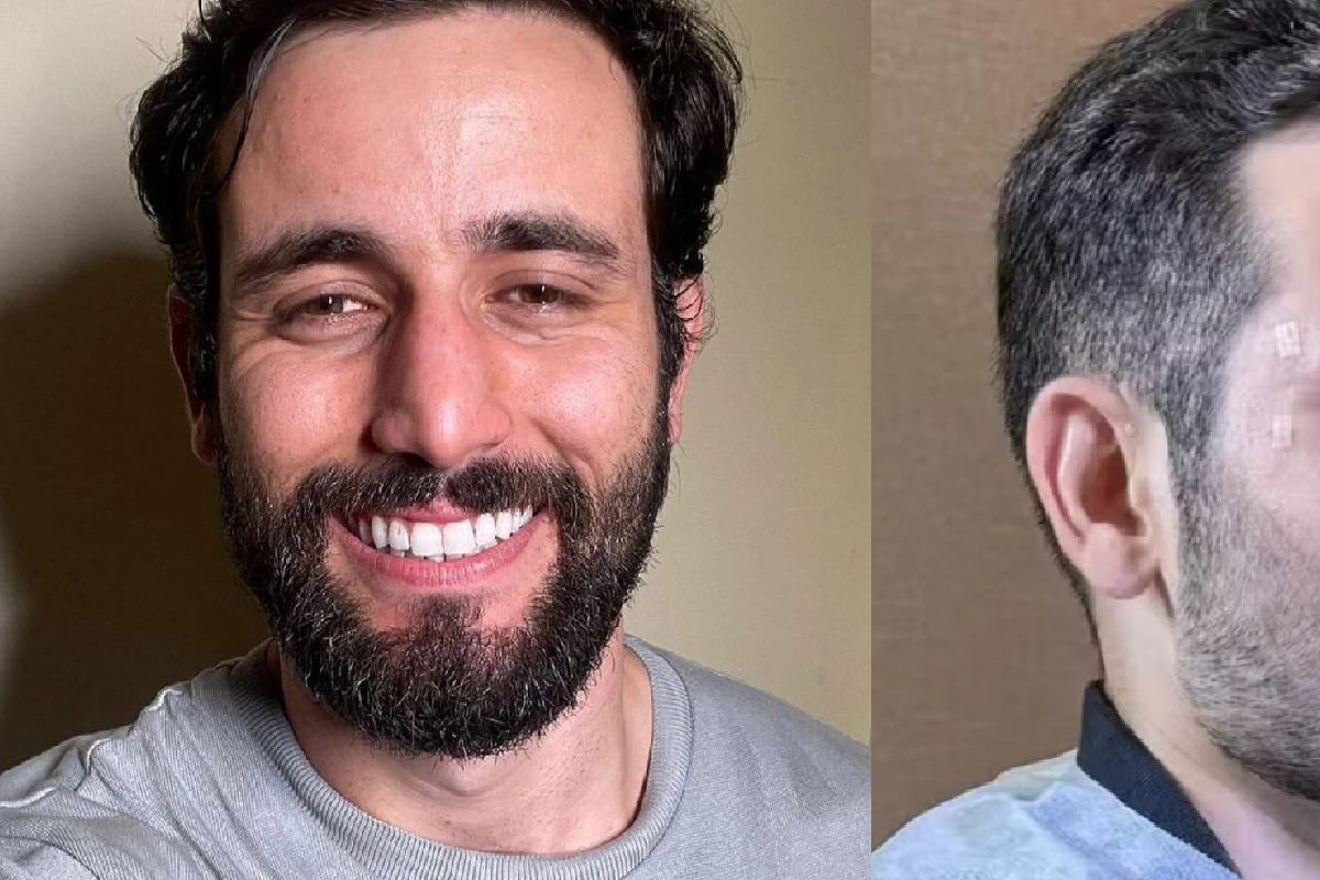 Matteus do BBB faz harmonização e surge com o rosto bem diferente: ‘bastante satisfeito’ 33 Matteus do BBB faz harmonizacao e surge com o rosto