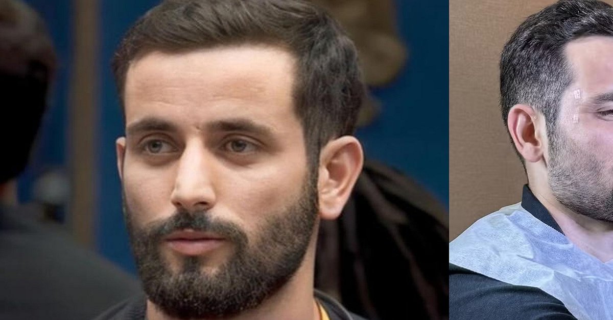 Transformado! Matteus Alegrete passa por harmonização e mostra o resultado 31 Transformado Matteus Alegrete passa por harmonizacao e mostra o resultado