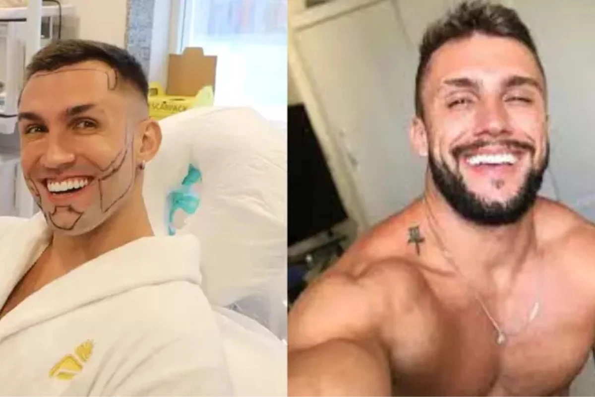 Vídeo – Arthur Picoli revela transplante capilar e transformação estética: ‘me incomodavam um pouco’ 31 Video – Arthur Picoli revela transplante capilar e transformacao estetica