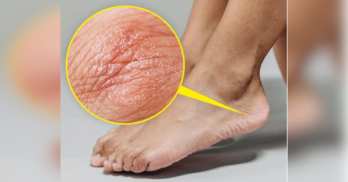 9 sinais de alerta que seus pés emitem sobre problemas de saúde que você pode ter em breve 47 9 sinais de alerta que seus pes emitem sobre problemas