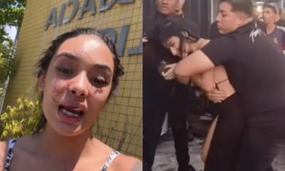 Com ferimentos no rosto mulher agredida por Bia Miranda e