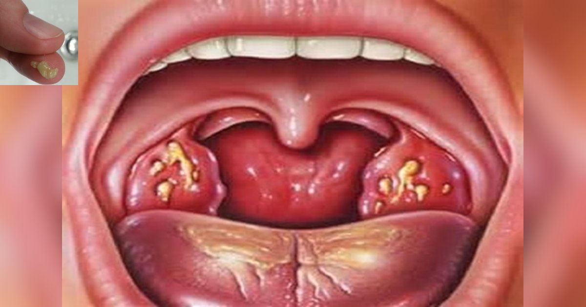Descubra o que são essas bolinhas fétidas que surgem na garganta e que podem incomodar bastante 31 Descubra o que sao essas bolinhas fetidas que surgem na