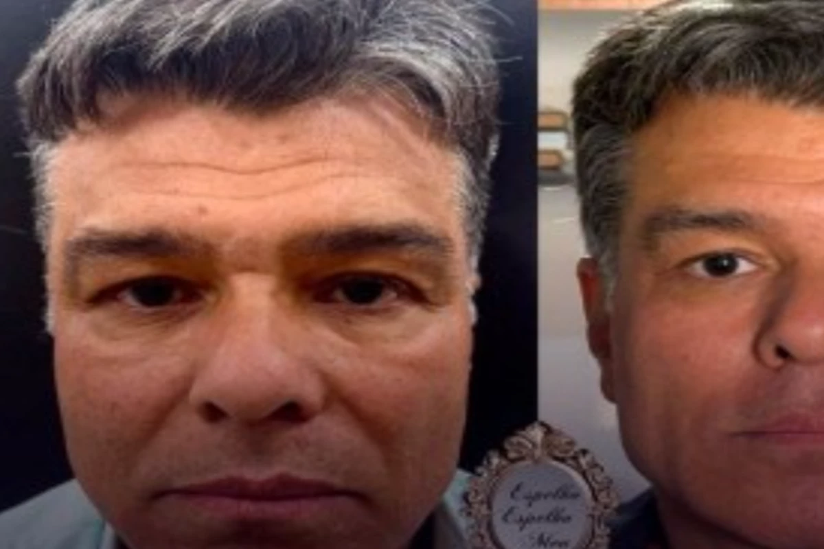 Maurício Mattar aparece bem diferente após fazer harmonização facial; veja o antes e depois 33 Mauricio Mattar aparece bem diferente apos fazer harmonizacao facial veja