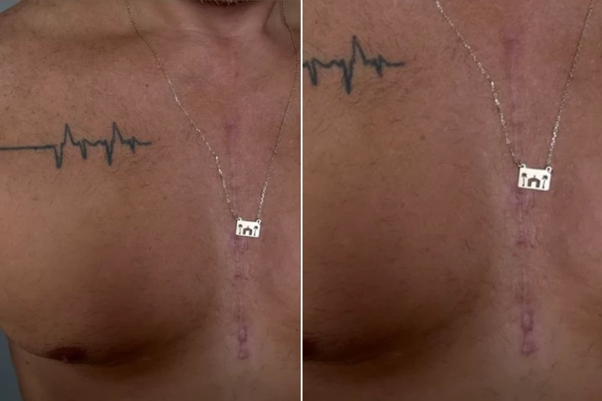Após passar por cirurgia cardíaca, ex-apresentador da Globo mostra a cicatriz e desabafa na web 35 Apos passar por cirurgia cardiaca ex apresentador da Globo mostra a